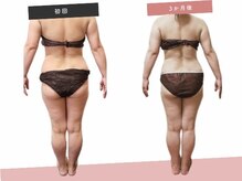 ヨサパーク アヴニール 練馬北町店(YOSA PARK Avenir)の雰囲気（腰肉、背肉・太腿の皮下脂肪解消、ヒップアップ！美肌にも！）