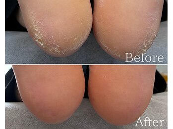 カシェット 広島店(Cachette)/20代女性☆かかと角質ケア40分