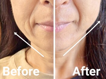 シャインアン(Shine'an)/小顔リフトアップ