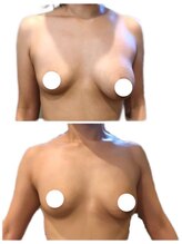 美人バスト 本厚木店/バストアップ◇症例◇