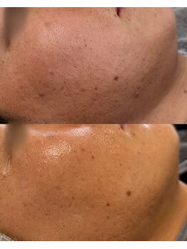 ラクシュミー(laksmi)の写真/プラズマニア/REVIハーブピーリング導入サロン**どうにもならない肌悩みはlaksmiで解決◎