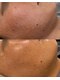 ラクシュミー(laksmi)の写真/プラズマニア/REVIハーブピーリング導入サロン**どうにもならない肌悩みはlaksmiで解決◎
