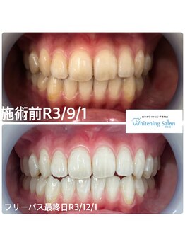 ホワイトニングサロン 熊本店/通いやすいホワイトニング