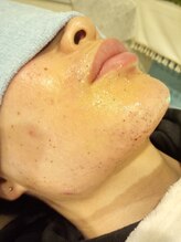 ミライズ(MIRAI'S)/男性人気No. 1★ヒゲ脱毛★(^_^)