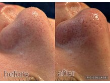 ナニミー(Nani.me)/ハイドラ毛穴洗浄