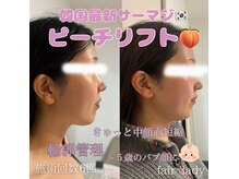フェア レディ(fair lady)の雰囲気（韓国最新サーマジ★ピーチリフト【プレミアムエイジング】）