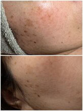 スパークル/フェイシャル/しみ／脱毛