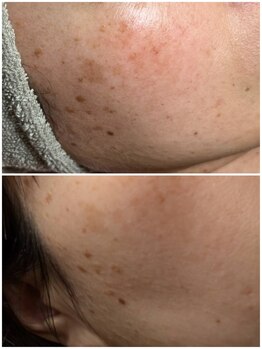 スパークル/フェイシャル/しみ/脱毛