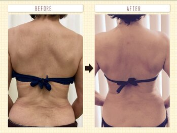 ブリーズベール(BRISE VERT)/お顔のリフトアップは背中から！