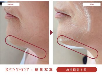 サバーイ サバーイ(SABAHI SABAHI)/【たるみ改善】半永久小顔形成