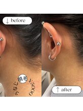 ミナミ/うなじ脱毛