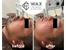 【匠道WAX】即ツル爽快感　メンズ脱毛◆ヒゲ脱毛　初回6600円