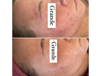 グランデ(Grande)/プラズマ＋ハーブの組み合わせ◎