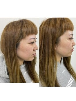 ナノハナ/鹿沼市の全身脱毛美容室ナノハナ