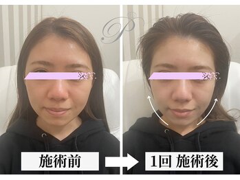 パールリフト 小田原店/20代の方の小顔とフェイスライン