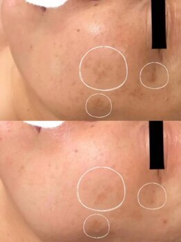 ラエッセ 目黒 白金台店(LAESSE)/毛穴・美白専門店 LAESSE 白金台