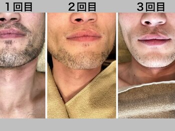 ルシェリ(Lecheri)/圧倒的スピード脱毛♪