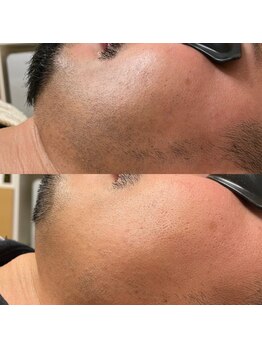 シャルム(Charme)/ヒゲ脱毛!脱毛ビフォーアフター