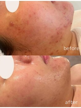 ピービー(PB)/メソプロ（MESOPRO+）