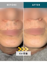 モモナ(Momona)/佐世保/脱毛/髭脱毛/全身脱毛