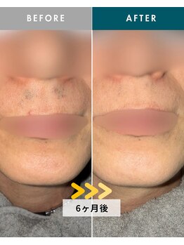 モモナ(Momona)/佐世保/脱毛/髭脱毛/全身脱毛