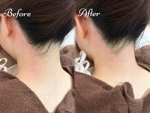 Beauty Salon PIMIL【４/４NEWOPEN（予定）】/うなじ脱毛