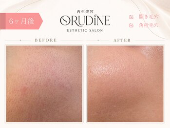 オルディーネ(ORUDiNE)/ 開き毛穴引き締め