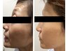 【人気No.3】最近老けた気がする方へ。たるみをしっかり引き上げ！