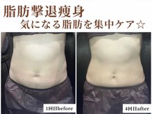 シン(Shin)/気になる脂肪に♪