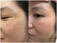 癒林(イーリン)/シミ改善