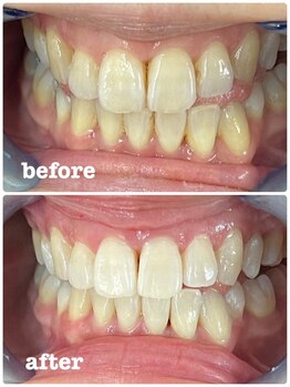 エクシアホワイトニング 札幌中島公園店/Before After［ホワイトニング］
