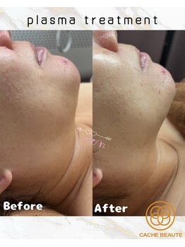 カシェボーテ(CACHE BEAUTE)/EMSで筋トレしながら小顔へ