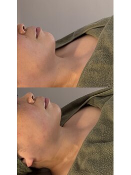 シーアイエステティック 船橋駅前店(c.iエステティック)/レモンボトル★ビフォーアフター