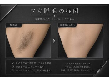 メンズラボ 京都山科店/脇脱毛で汗・ニオイ・ムレを軽減