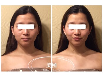 美極 銀座店/銀座/小顔コルギ/小顔矯正