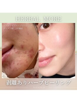 ハーブのほし/ニキビケア!改善!美肌が叶う