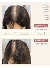 スカルプラボ 倉敷店(Scalp Lab)/moumitu3ヶ月症例