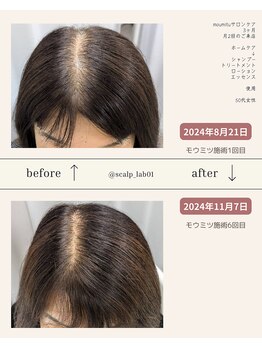 スカルプラボ 倉敷店(Scalp Lab)/moumitu3ヶ月症例