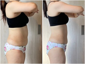 インプルーブ 浜北店(Improve)/へそ周り-10ｃｍ！　30代女性