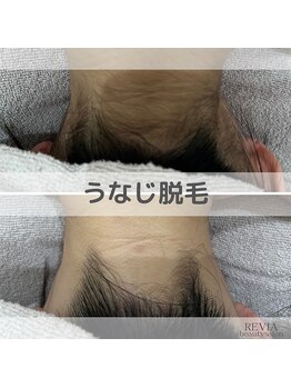 レヴィア(REVIA)/うなじ脱毛