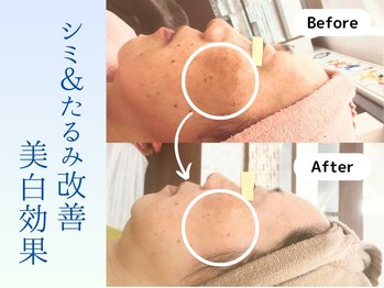 ブルービー(BLUE bee)/シミタルミ改善