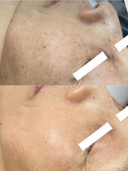 ラエッセ 目黒 白金台店(LAESSE)/毛穴・美白専門店 LAESSE 白金台