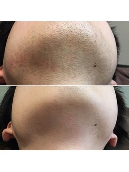 トリプルワン(111)/ヒゲ脱毛（光脱毛）