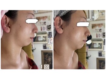 アルページュ(Arpege)の写真/韓国話題♪エステ版チタニウムリフト【小顔輪郭×高ハリ×色白シミケア×毛穴レス】一度で叶う欲張り美容