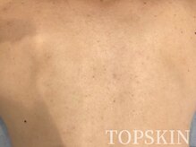 トップスキン 久屋大通(TOPSKIN)/背中ハーブピーリング♪男性もOK