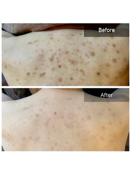 ビビ(VIVI)/背中ニキビケアハーブピーリング