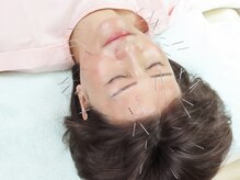 鍼灸チェリーハンド/通常美容鍼