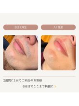 アネラリラクシス(Anera Relaxsis)/メンズヒゲ脱毛6回施術