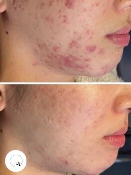 LUNEAの写真/何年も消えないニキビケアに終止符。肌質別オーダーメイドハーブピーリングで、色むら・赤みを根本ケア◎