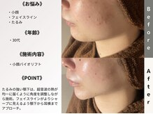 ルディラ医療提携エステ 立川店 毛穴/小顔/ニキビ・シミ・美白・シワ・たるみケア/小顔バイオリフト